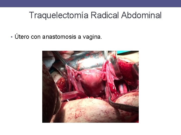 Traquelectomía Radical Abdominal • Útero con anastomosis a vagina. 