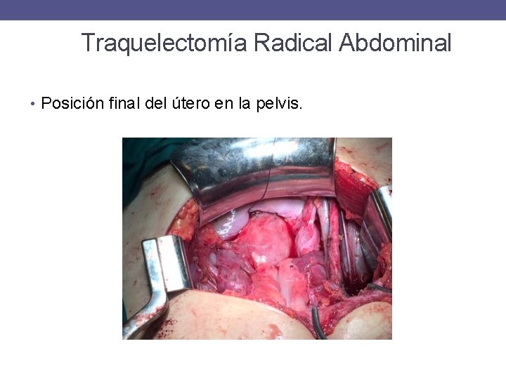 Traquelectomía Radical Abdominal • Posición final del útero en la pelvis. 