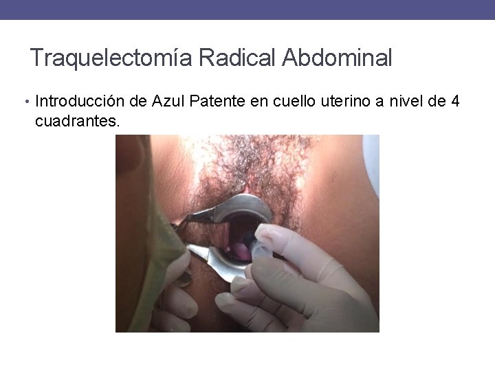 Traquelectomía Radical Abdominal • Introducción de Azul Patente en cuello uterino a nivel de