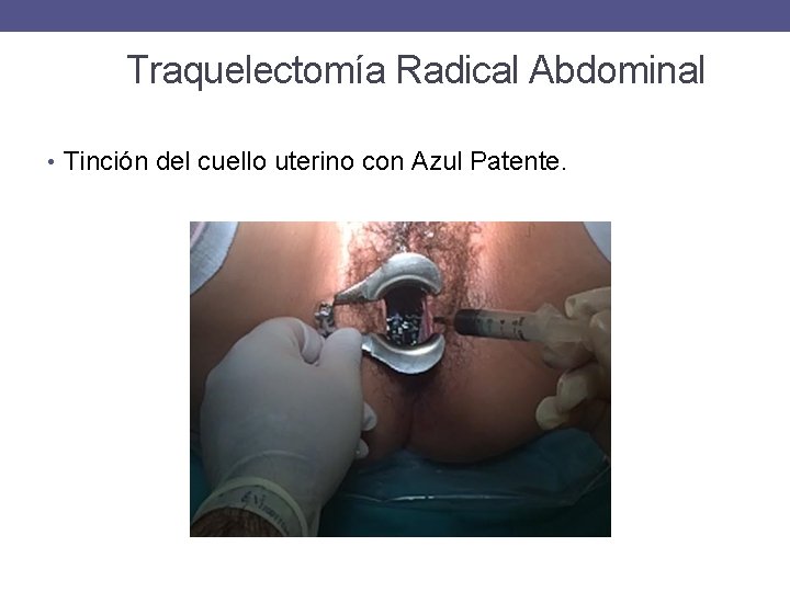 Traquelectomía Radical Abdominal • Tinción del cuello uterino con Azul Patente. 