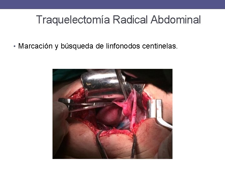 Traquelectomía Radical Abdominal • Marcación y búsqueda de linfonodos centinelas. 