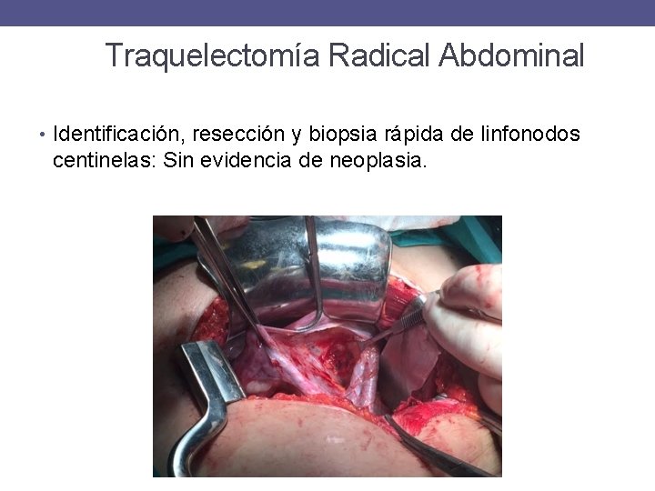 Traquelectomía Radical Abdominal • Identificación, resección y biopsia rápida de linfonodos centinelas: Sin evidencia