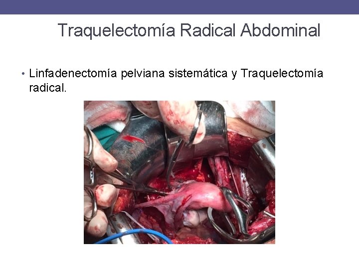 Traquelectomía Radical Abdominal • Linfadenectomía pelviana sistemática y Traquelectomía radical. 