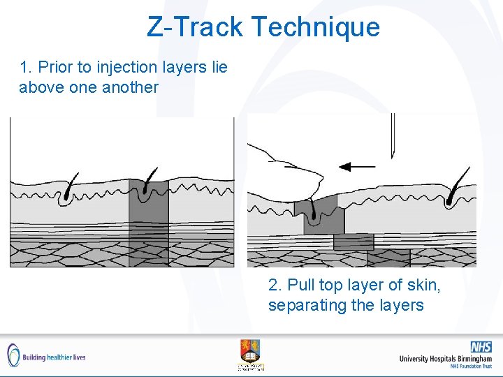 Z-Track Technique 1. Prior to injection layers lie above one another 2. Pull top