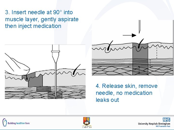 3. Insert needle at 90° into muscle layer, gently aspirate then inject medication 4.