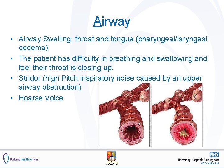 Airway • Airway Swelling; throat and tongue (pharyngeal/laryngeal oedema). • The patient has difficulty Airway • Airway Swelling; throat and tongue (pharyngeal/laryngeal oedema). • The patient has difficulty