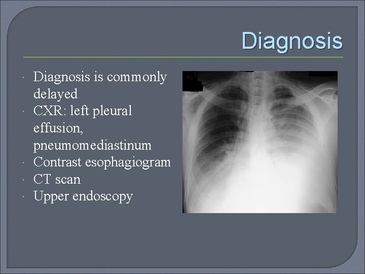 Diagnosis Diagnosis is commonly delayed CXR: left pleural effusion, pneumomediastinum Contrast esophagiogram CT scan
