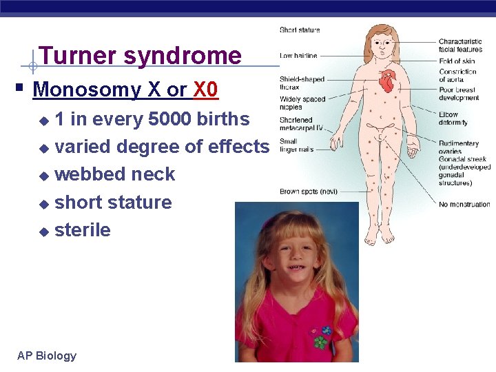 Turner syndrome § Monosomy X or X 0 1 in every 5000 births u