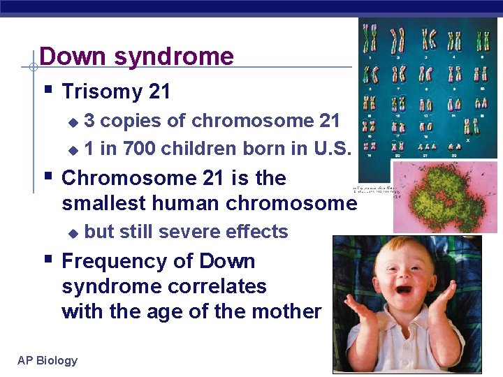 Down syndrome § Trisomy 21 3 copies of chromosome 21 u 1 in 700