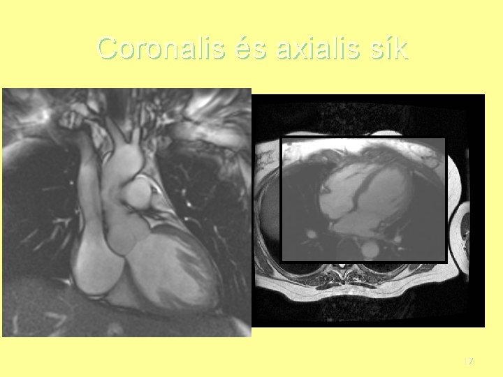 Coronalis és axialis sík 17 