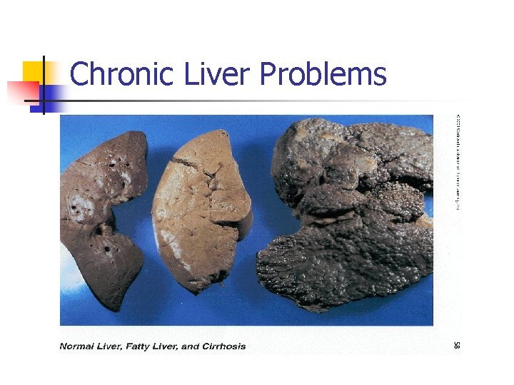 Chronic Liver Problems 