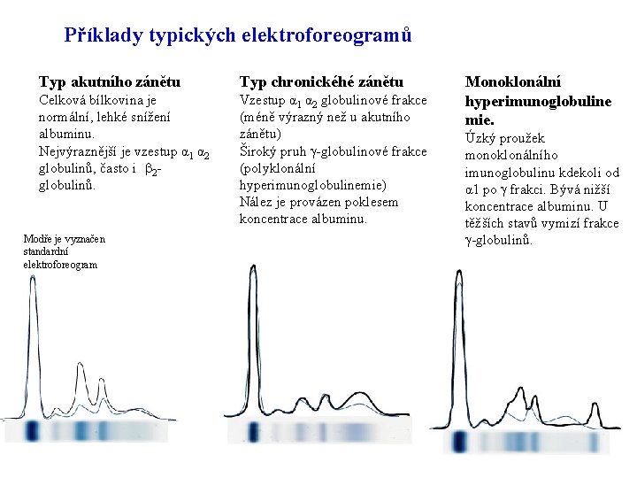 Příklady typických elektroforeogramů Typ akutního zánětu Typ chronickéhé zánětu Celková bílkovina je normální, lehké