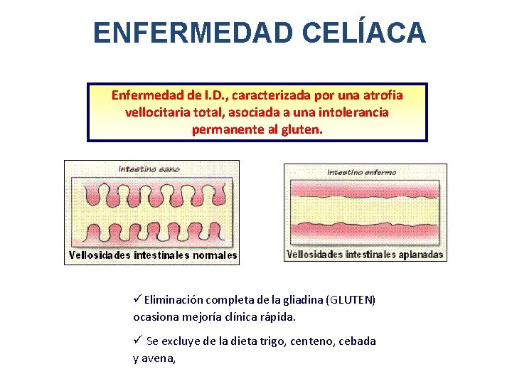 ENFERMEDAD CELÍACA Enfermedad de I. D. , caracterizada por una atrofia vellocitaria total, asociada