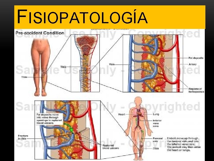 FISIOPATOLOGÍA 