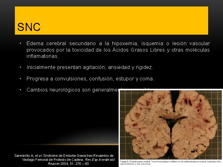 SNC • Edema cerebral secundario a la hipoxemia, isquemia o lesión vascular provocados por