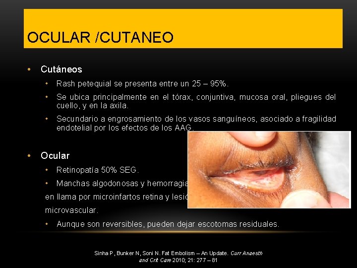OCULAR /CUTANEO • • Cutáneos • Rash petequial se presenta entre un 25 –