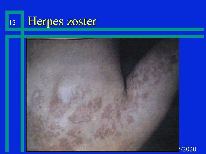 12 Herpes zoster 10/25/2020 
