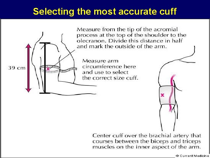 Selecting the most accurate cuff 