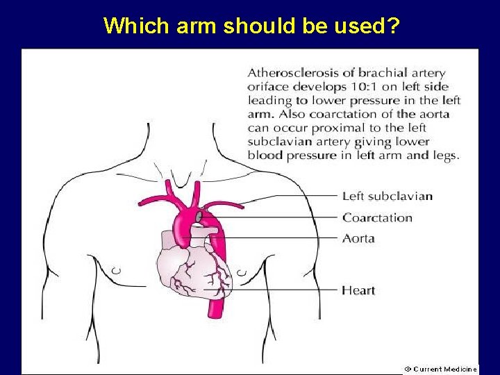 Which arm should be used? 