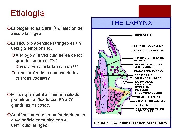 Etiología ¡ Etiología no es clara dilatación del sáculo laríngeo. ¡ El sáculo o