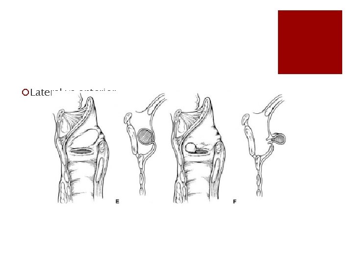 ¡Lateral vs anterior 