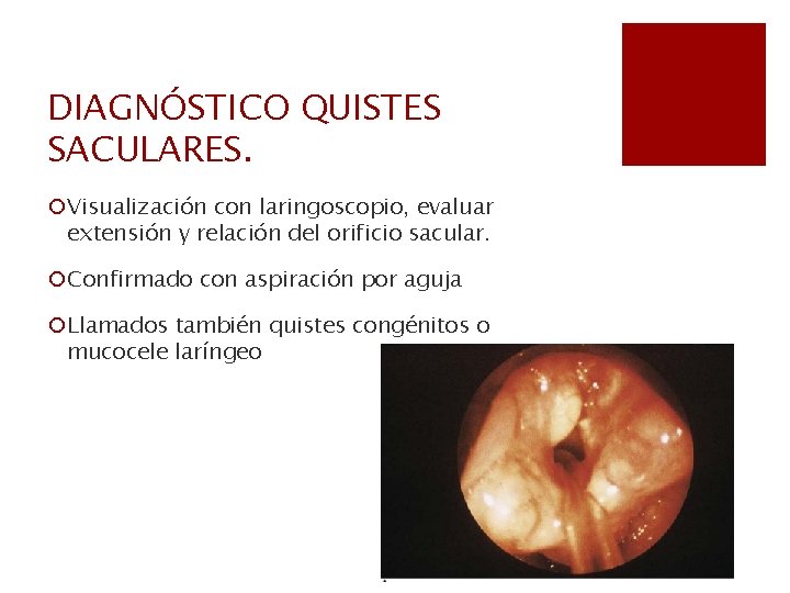 DIAGNÓSTICO QUISTES SACULARES. ¡Visualización con laringoscopio, evaluar extensión y relación del orificio sacular. ¡Confirmado