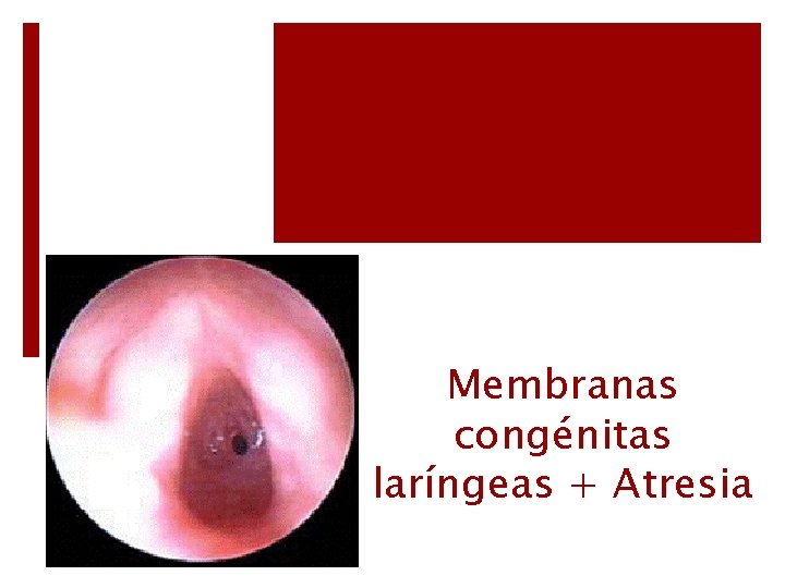 Membranas congénitas laríngeas + Atresia 