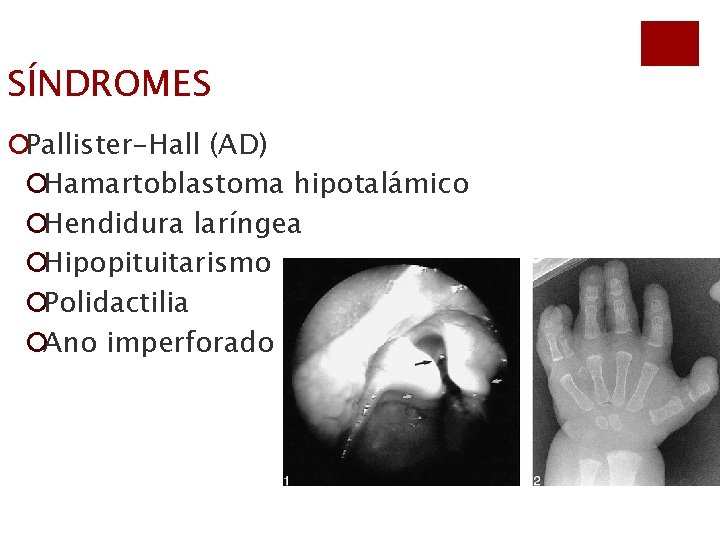 SÍNDROMES ¡Pallister-Hall (AD) ¡Hamartoblastoma hipotalámico ¡Hendidura laríngea ¡Hipopituitarismo ¡Polidactilia ¡Ano imperforado 