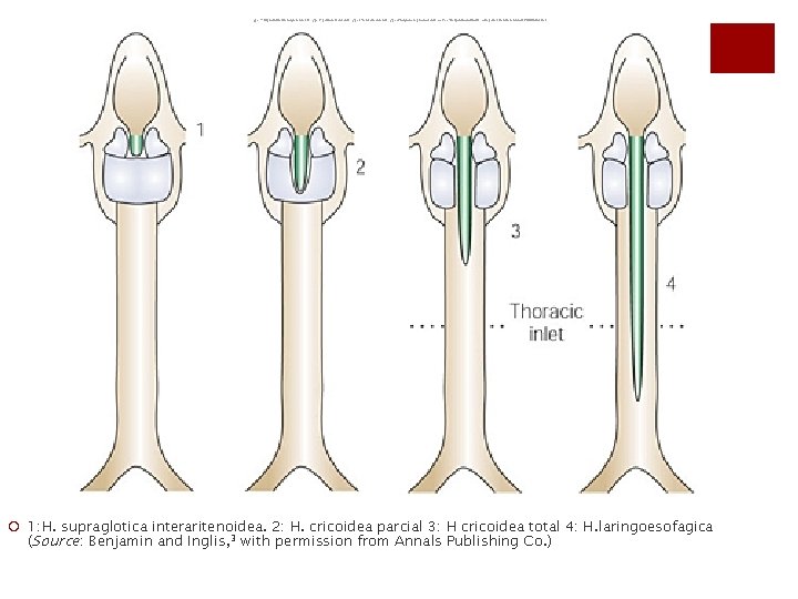 Type 1: supraglottic interarytenoid cleft. Type 2: partial cricoid cleft. Type 3: total cricoid