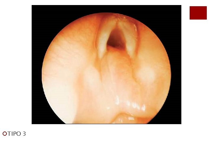 ¡TIPO 3 