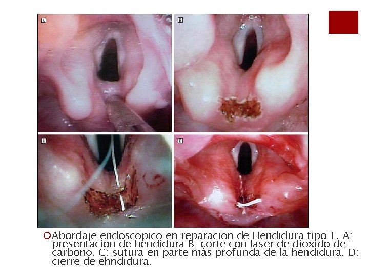¡Abordaje endoscopico en reparacion de Hendidura tipo 1. A: presentacion de hendidura B: corte
