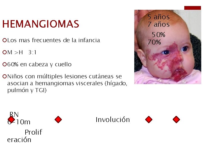 HEMANGIOMAS ¡Los mas frecuentes de la infancia ¡M >H 3: 1 ¡ 60% en