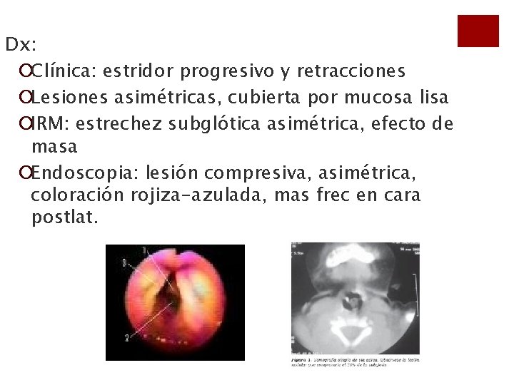 Dx: ¡Clínica: estridor progresivo y retracciones ¡Lesiones asimétricas, cubierta por mucosa lisa ¡IRM: estrechez