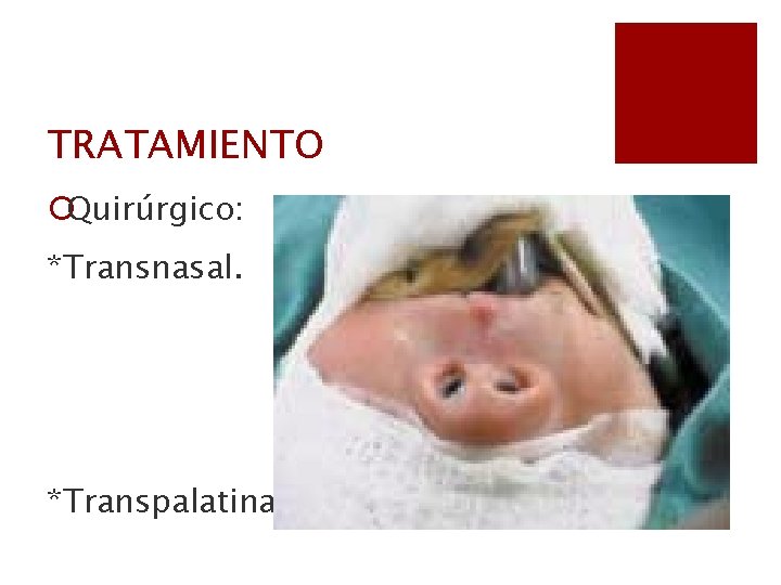 TRATAMIENTO ¡Quirúrgico: *Transnasal. *Transpalatina. 