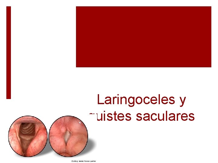 Laringoceles y quistes saculares 