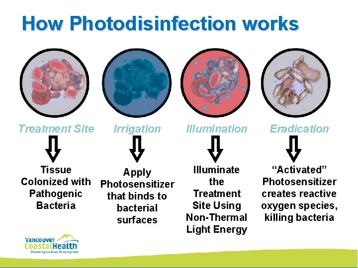 How Photodisinfection works Treatment Site Irrigation Tissue Apply Colonized with Photosensitizer Pathogenic that binds