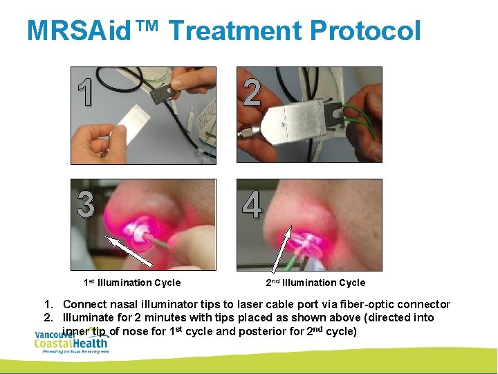 MRSAid™ Treatment Protocol 1 2 3 4 1 st Illumination Cycle 2 nd Illumination