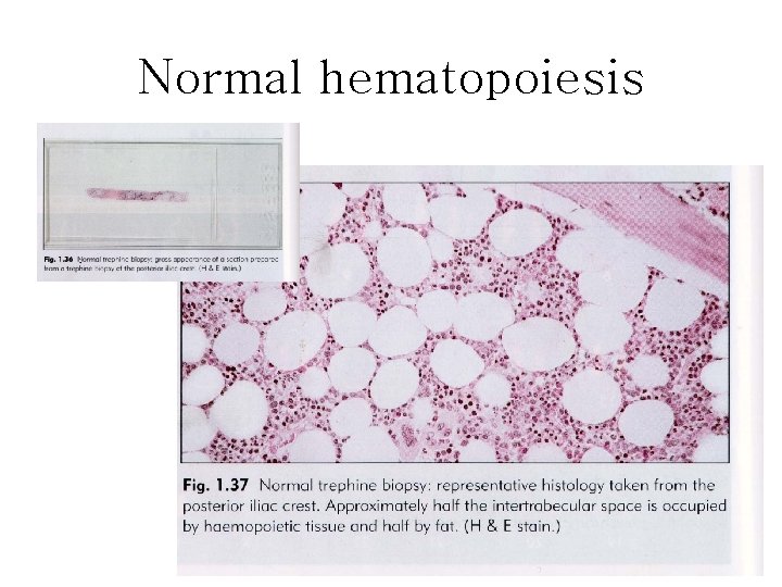 Normal hematopoiesis Normal hematopoiesis