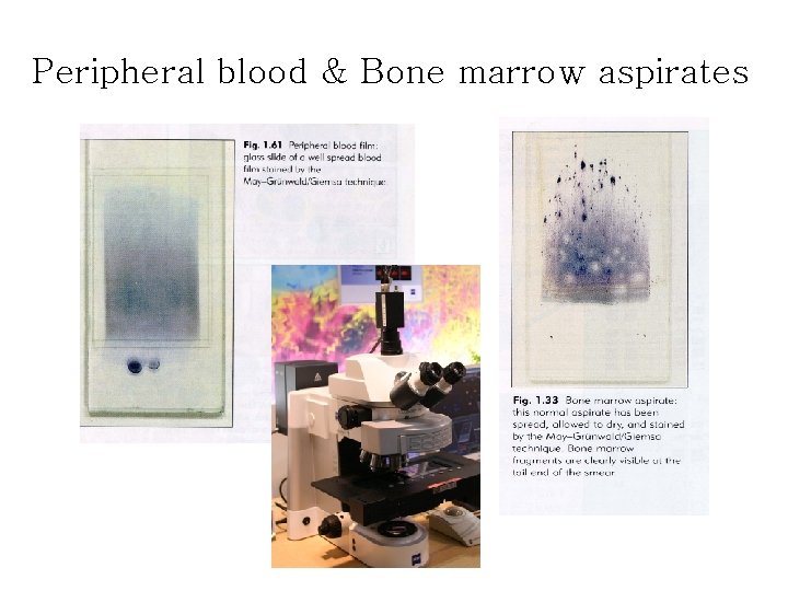 Peripheral blood & Bone marrow aspirates 