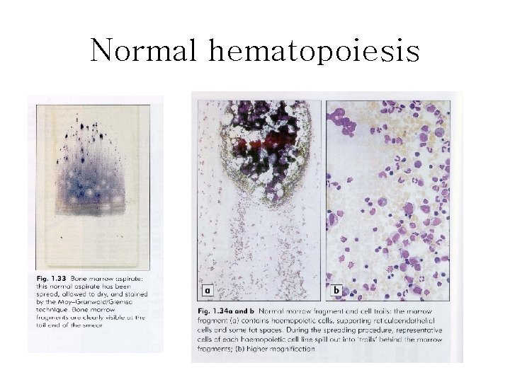 Normal hematopoiesis Normal hematopoiesis