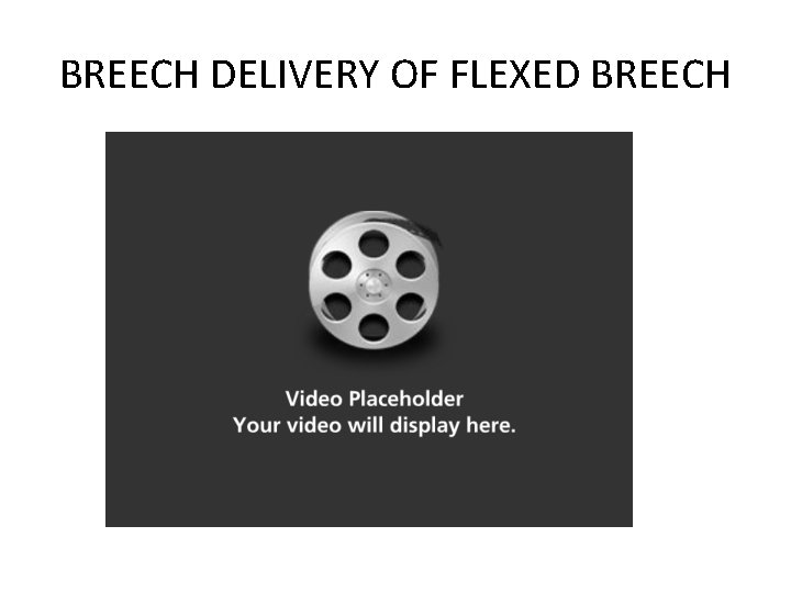 BREECH DELIVERY OF FLEXED BREECH 