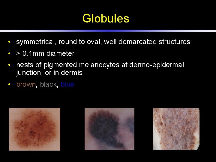 Globules • symmetrical, round to oval, well demarcated structures • > 0. 1 mm