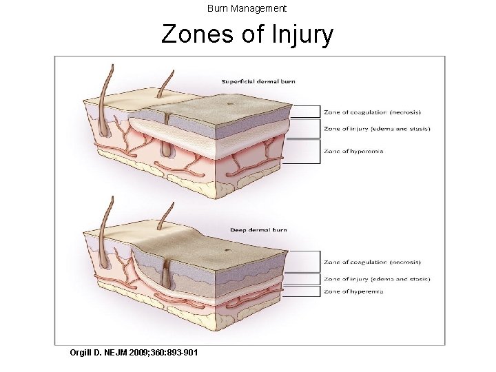 Burn Management Zones of Injury Orgill D. NEJM 2009; 360: 893 -901 