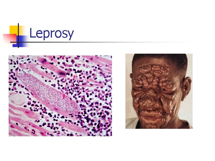 Leprosy 