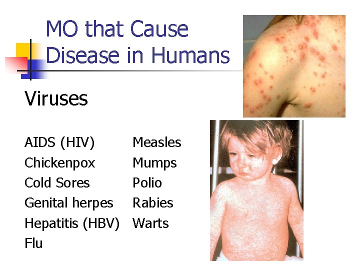 MO that Cause Disease in Humans Viruses AIDS (HIV) Chickenpox Cold Sores Genital herpes