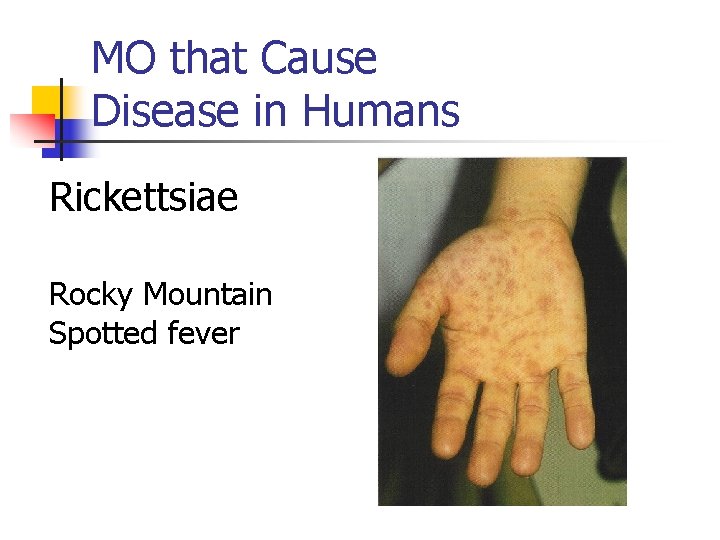 MO that Cause Disease in Humans Rickettsiae Rocky Mountain Spotted fever 