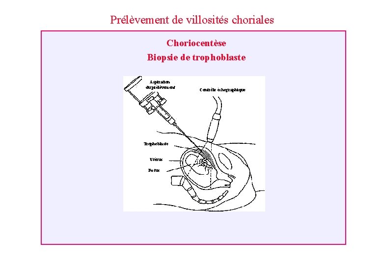 Prélèvement de villosités choriales Choriocentèse Biopsie de trophoblaste Aspiration du prélèvement Trophoblaste Utérus Fœtus