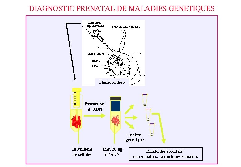 DIAGNOSTIC PRENATAL DE MALADIES GENETIQUES Aspiration du prélèvement Contrôle échographique Trophoblaste Utérus Fétus Choriocentèse