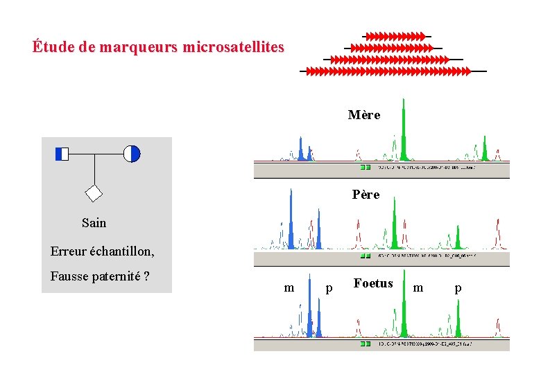 Étude de marqueurs microsatellites Mère Père Sain Erreur échantillon, Fausse paternité ? m p