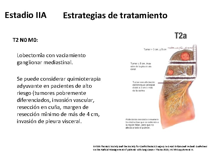 Estadio IIA Estrategias de tratamiento T 2 N 0 M 0: Lobectomi a con